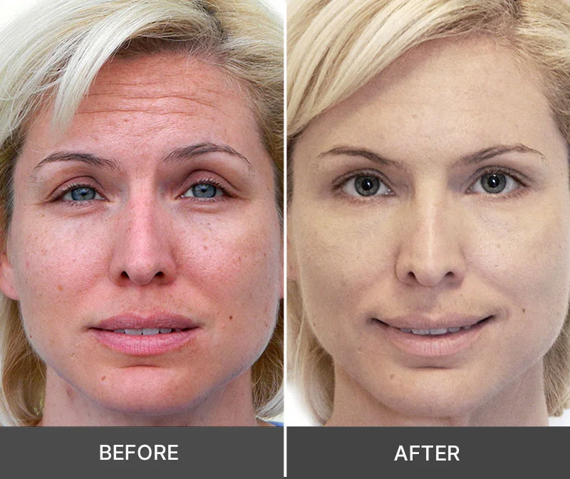 Woman with beautiful radiant skin after using Idrotherapy